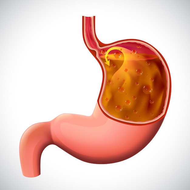 Иллюстрация гастроэзофагеальной рефлюксной болезни для медицинского и образовательного использования