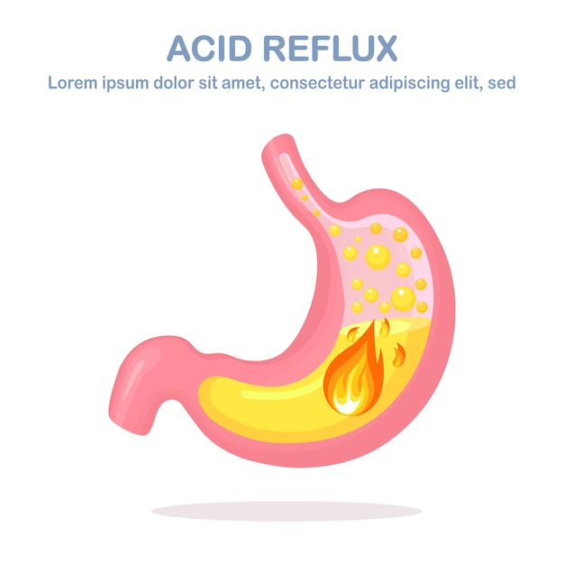 Gastroesophageal reflux disease illustration