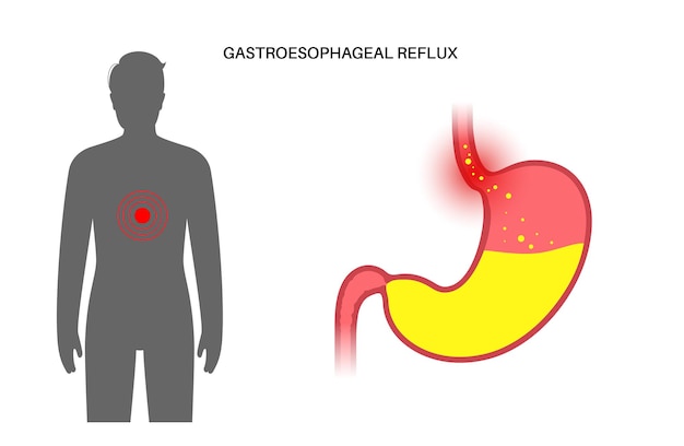 Плакат гастроэзофагеальной рефлюксной болезни. Расстройство пищеварения и проблема ГЭРБ в организме человека. Боль, изжога в груди, желудке и пищеводе. Открытый сфинктер позволяет иллюстрировать плоский вектор кислотного рефлюкса.