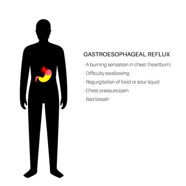 역류성 식도염 포스터. 남성 인체의 소화 장애 및 GERD 문제. 가슴, 위, 식도의 통증, 속쓰림. 개방형 괄약근은 위산 역류 벡터 일러스트레이션을 허용합니다.