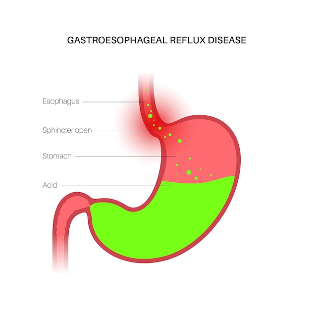 Vector gastroesophageal reflux disease