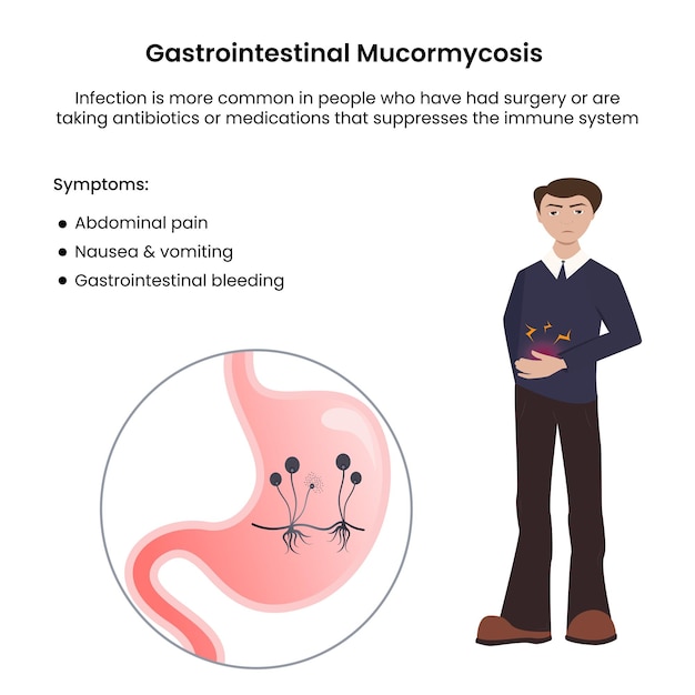 위장 또는 기본 위 점막 균증 검은 곰팡이 감염 벡터 일러스트 레이션