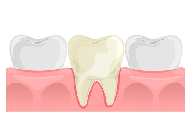 Gele tand in vlakke stijl Tanden en tandvlees anatomie Tandheelkundige gezondheid Vector illustratie geïsoleerd op wit