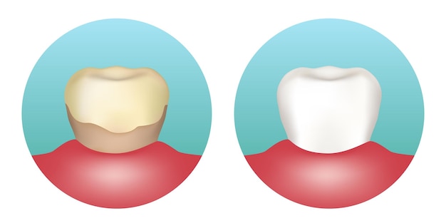 Gele tand met tandsteen en witte tand Vectorillustratie