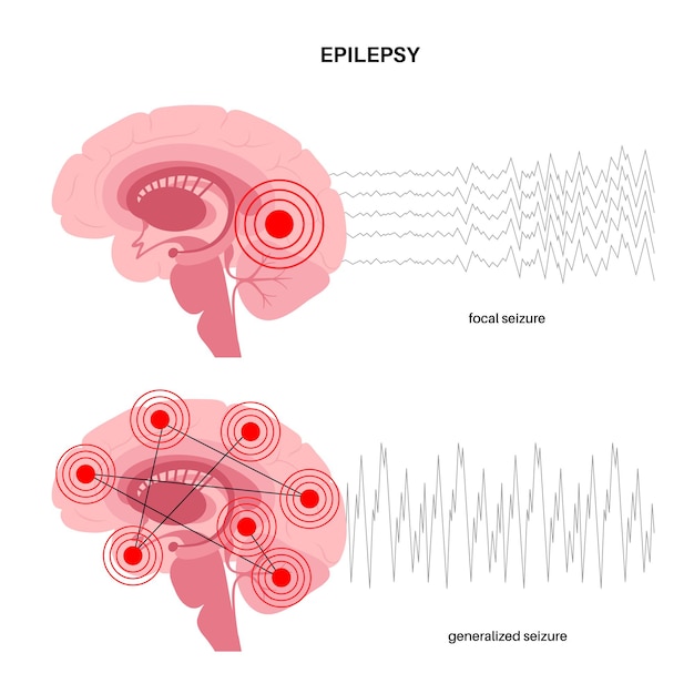 Crisi generalizzata e parziale. epilessia e attività cerebrale anormale. vettore di ricerca medica