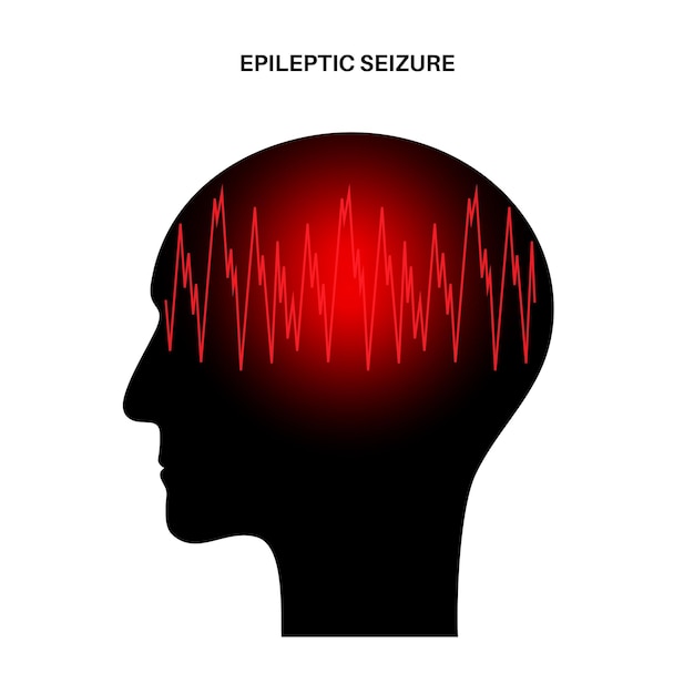 Generalized or partial seizure. epilepsy and abnormal brain activity. pain or migraine in human head