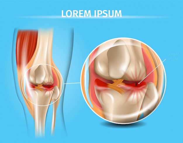 Gewricht kniegewricht met gescheurde meniscus vector grafiek