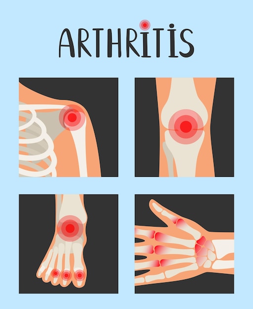 Vector gewrichten van het menselijk skelet met pijn rode stippen reumatoïde artritis vector illustratie over ontsteking