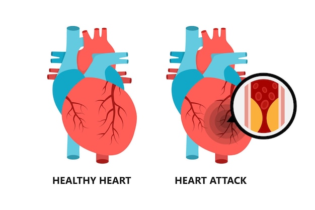 Vector gezond en ongezond hart hart met atherosclerotische plaque cholesterolplaque in de bloedvaten