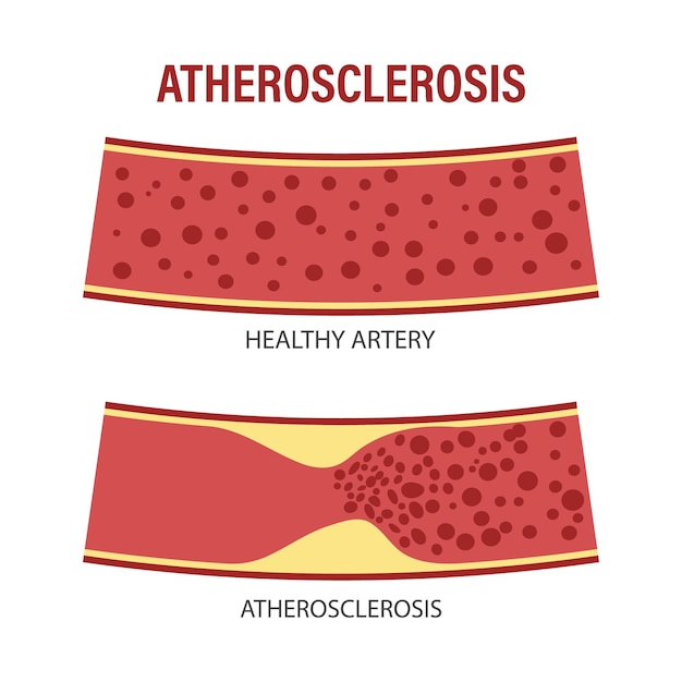 Vector gezonde en atherosclerotische vaten met bloedcellen cholesterol in bloedvaten atherosclerotisch