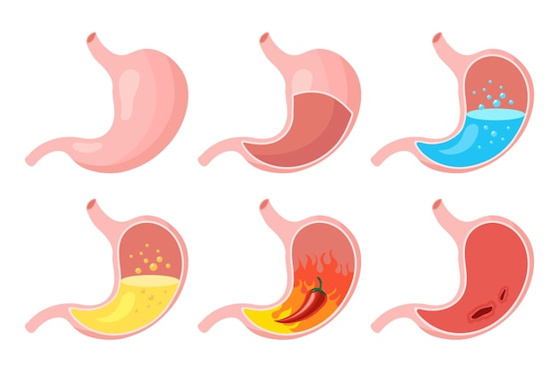 Gezonde en ongezonde, lege en volle menselijke maag in vlakke stijl, iconen set. Anatomie