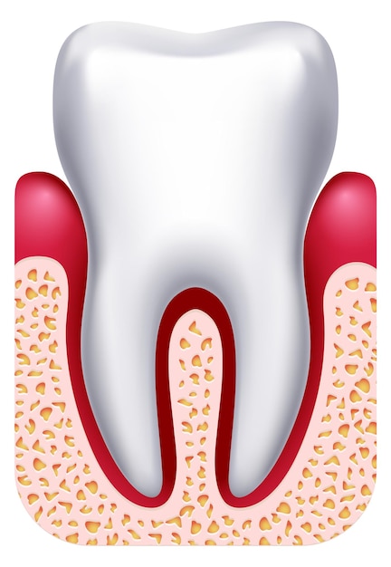 Vector gingivitis illustration gum disease dental treatment drawing