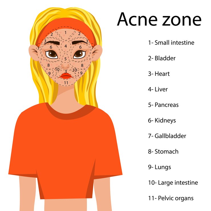 Vector girl with a scheme of problem areas on her face with a predisposition to acne. cartoon style.
