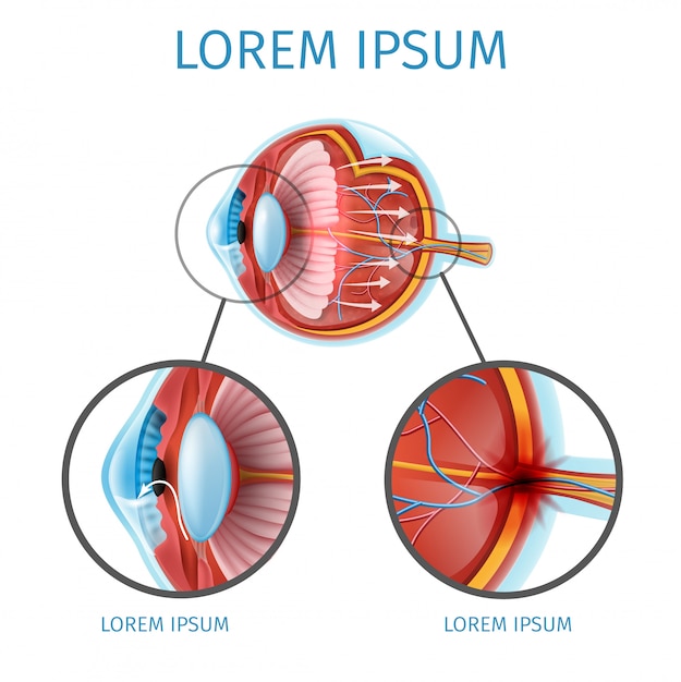 Glaucoma Vector Schema