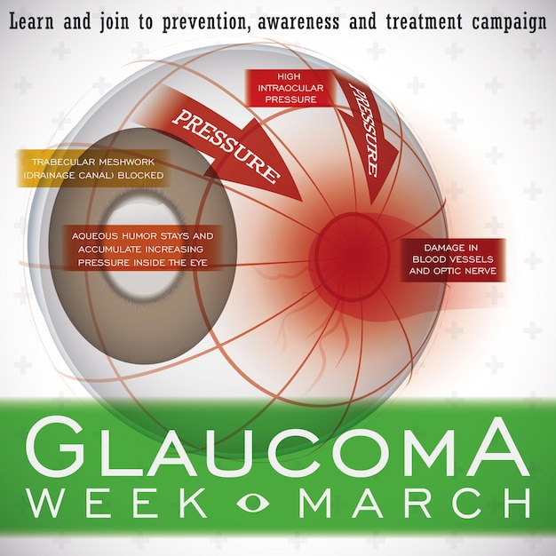 Disegno della settimana del glaucoma con una descrizione di questa malattia oculare