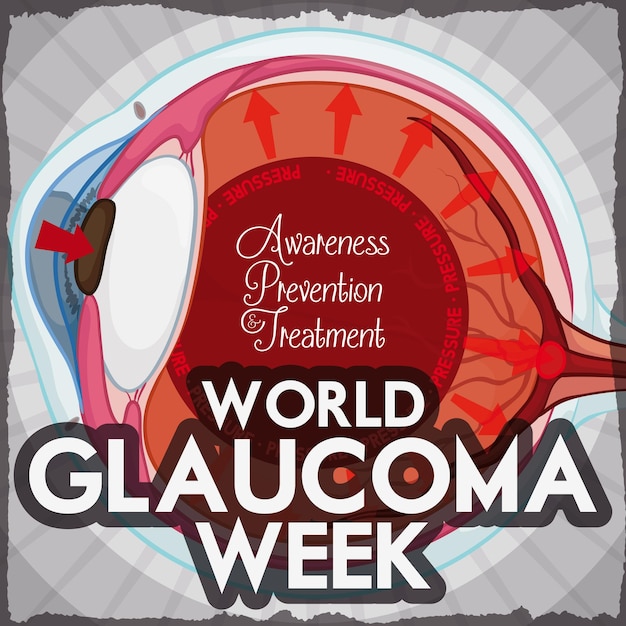 고 intraocular 압력에 대한 눈에 영향을 미치는 Glaucoma Week 설계