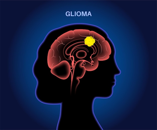 Glioma hersenkanker