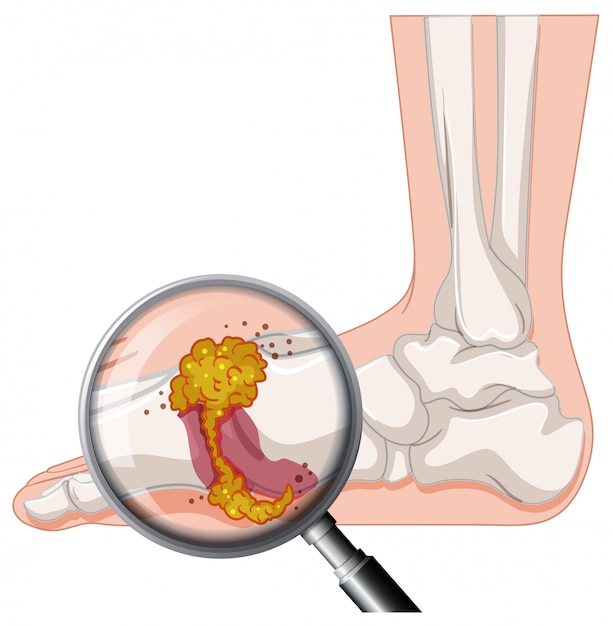 Vector gout in human foot