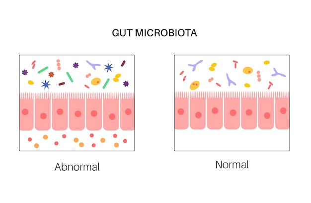 Gut brain connection dysbiosis and microbiome normal and abnormal microbiota