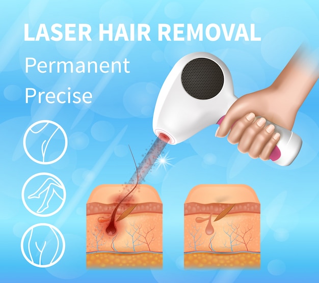 Haarlaser verwijderen, permanente precieze banner.