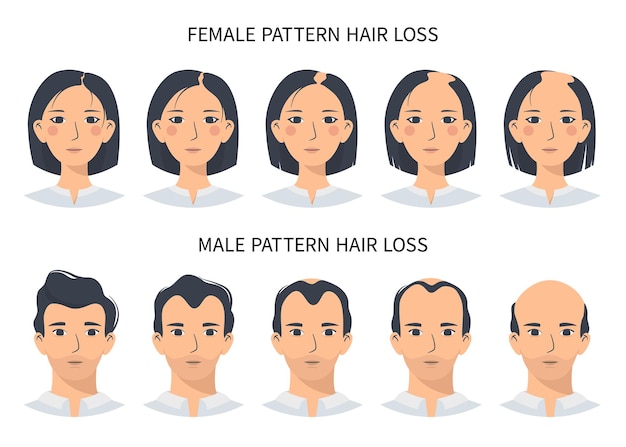 Вектор Стадии выпадения волос при андрогенетической алопеции по мужскому и женскому типу
