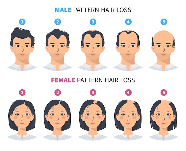 Premium Vector | Hair loss stages androgenetic alopecia male or female  pattern and steps of baldness
