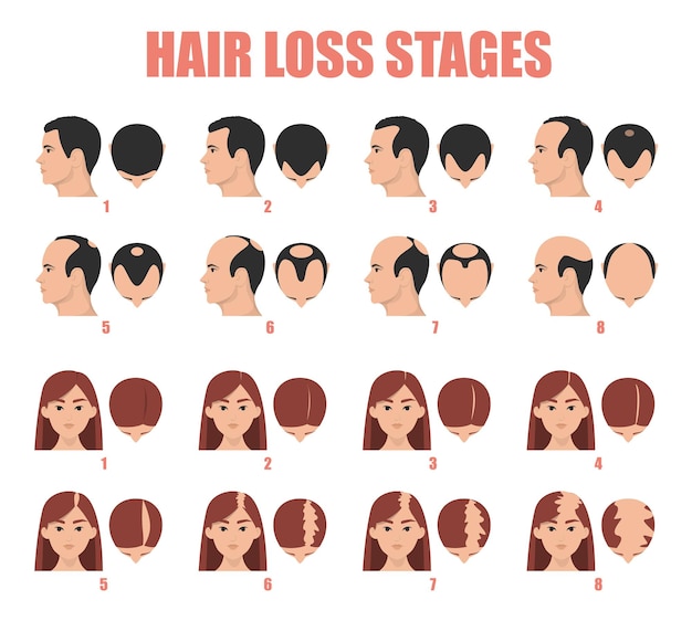 Vector hair loss stages of female and male alopecia