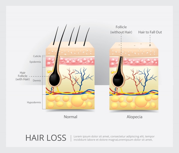 Hair loss structure vector illustration