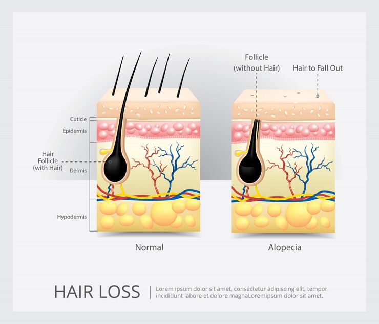 Vector hair loss structure vector illustration