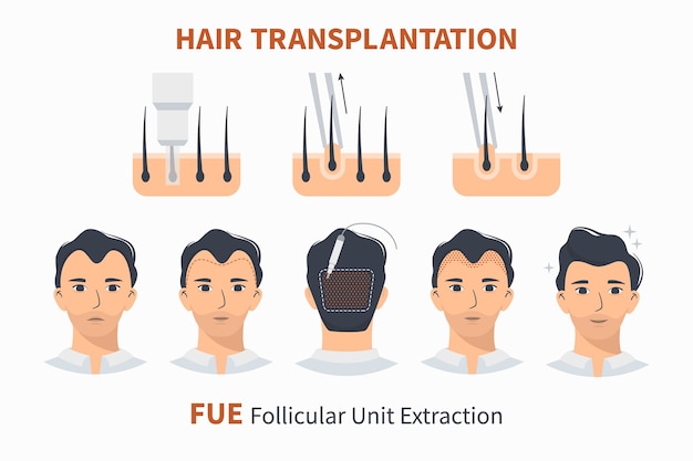 Hair transplantation fue follicular unit extraction