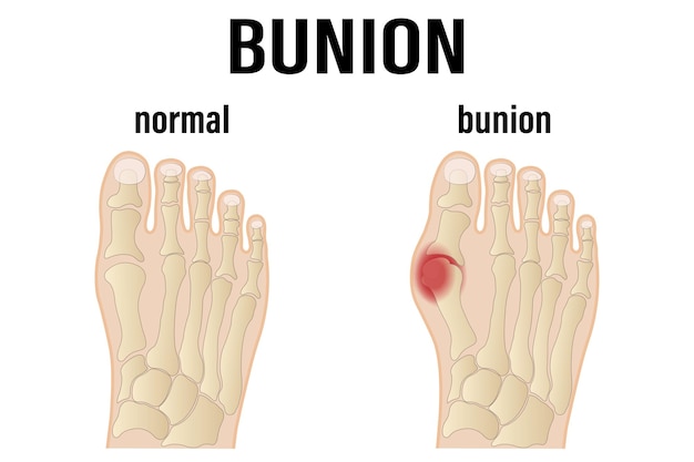 Hallux valgus медицинская инфографика. Векторная иллюстрация.