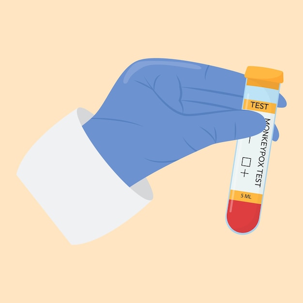 The hand of a doctor in a protective glove holds a test tube Monkeypox virus test Test systems