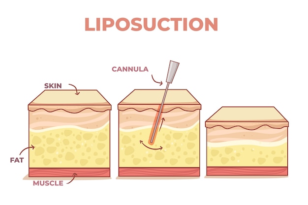 Hand drawn flat design liposuction infographic