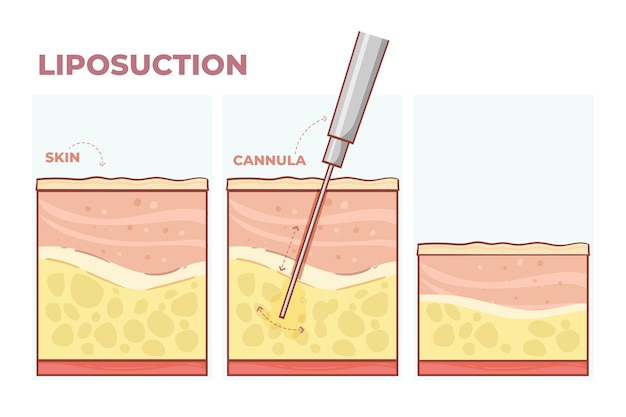 hand drawn flat design liposuction infographic