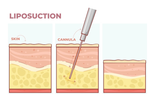 Hand drawn flat design liposuction infographic