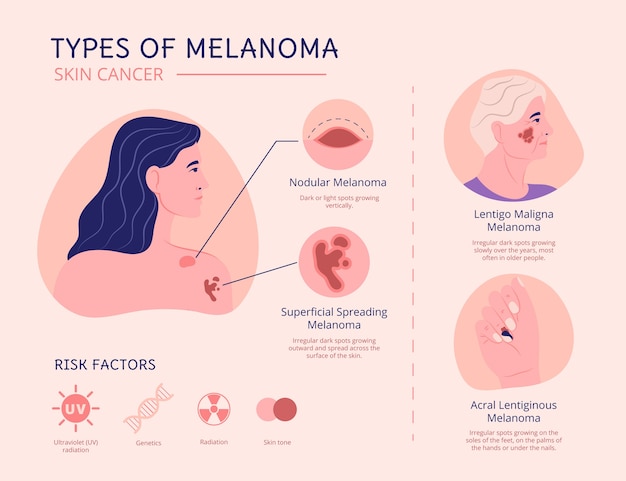 Hand drawn flat design melanoma infographic