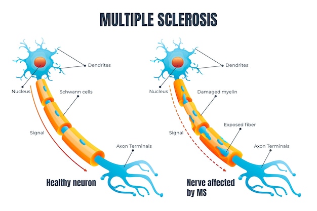 Vector hand drawn flat design multiple sclerosis illustration