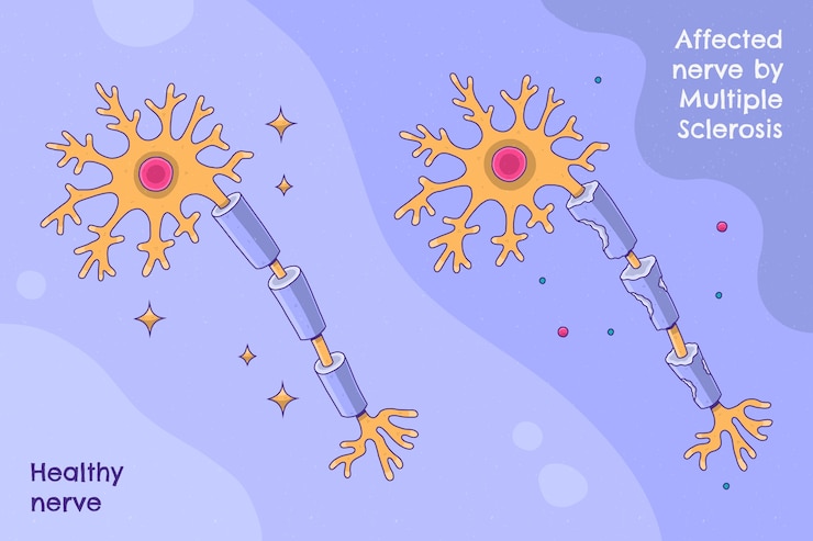 Vector hand drawn flat design multiple sclerosis illustration