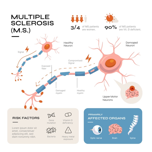 Infografica sulla sclerosi multipla dal design piatto disegnato a mano