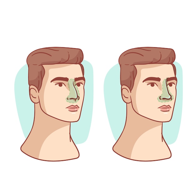 Vector hand drawn rhinoplasty illustration