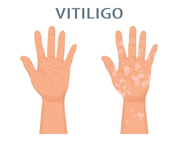 Handen met dermatologische ziekte vitiligo. Geneeskunde concept. Wereld vitiligodag, bewustmakingsbanner.