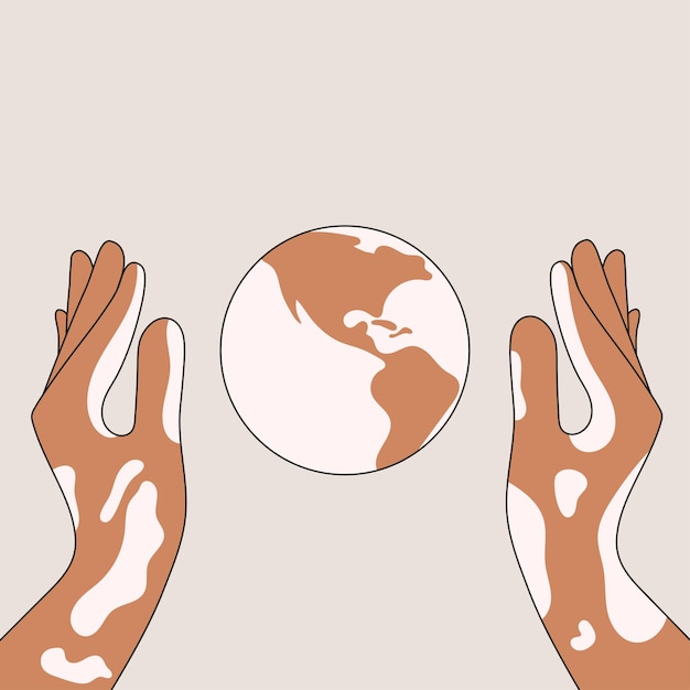 Vector handen van een persoon met vitiligo huidziekte houden voorzichtig de planeet plat vectorillustratie