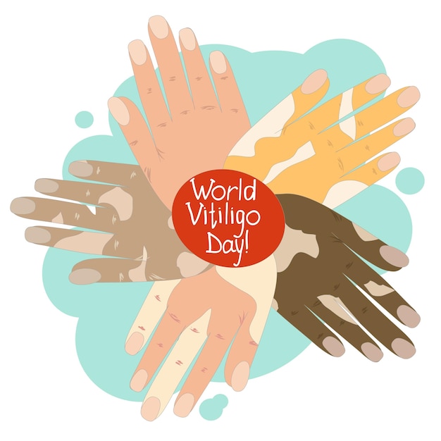 Handen van lichte en donkere huid met depigmentatie van vitiligo