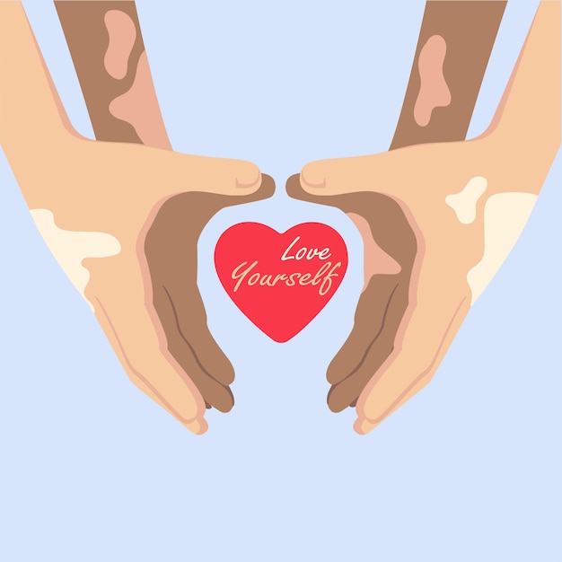 Hands with vitiligo depigmantation forming a heart shape symbol. Love yourself concept.