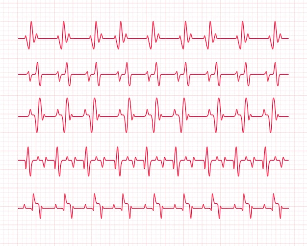 Hartritmegrafiek uw hartslag controleren voor diagnose