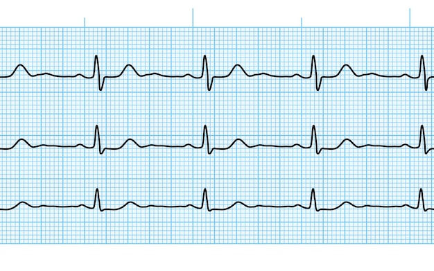 Hartslag ecg of ekg naadloze zwarte lijn op blauw papier