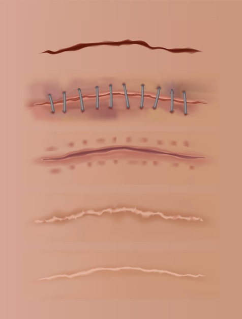 ベクトル 癒しの傷は、皮膚の傷跡を縫い合わせた切り傷を設定し、人間の皮膚の背景のさまざまな治癒段階で現実的な外科用縫合糸を縫い合わせた傷をカットします