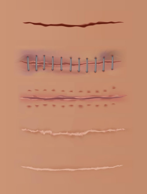 치유 상처는 피부 상처를 꿰매고 상처를 꿰매고 인간 피부 배경의 다른 치유 단계에서 현실적인 외과 봉합사 꿰매어 진 상처