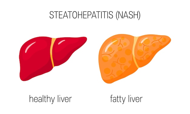 Vector healthy and fatty liver in flat style.