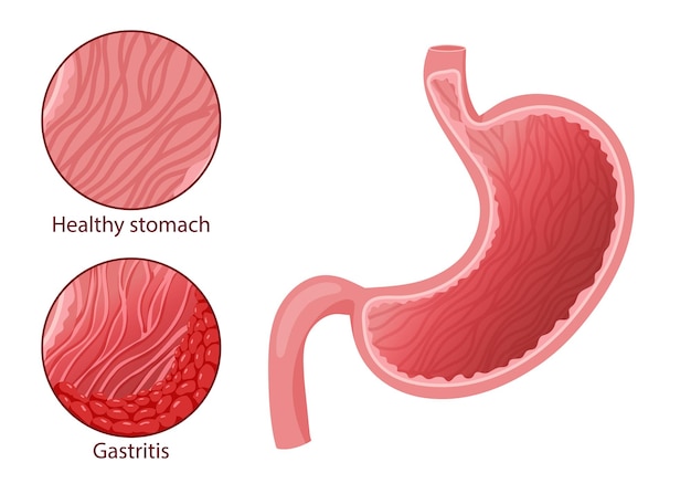 Se cura la gastritis atrófica